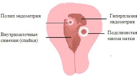Гиперплазия эндометрия