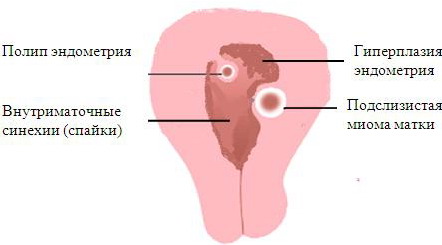 ГИПЕРПЛАЗИЯ ЭНДОМЕТРИЯ    