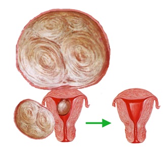 Состояние матки до и после лечения миомы
