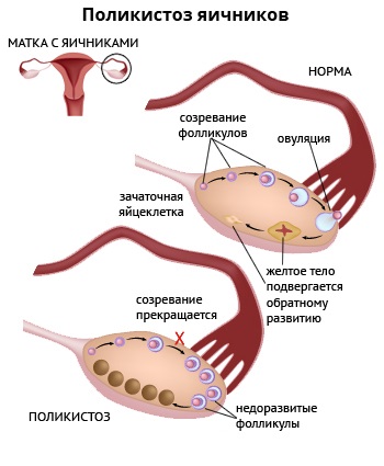 Схематическое изображение развития поликистоза яичников у женщин