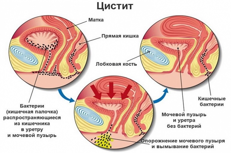 Схема, как инфекция попадает в мочевой пузырь женщины и вызывает его воспаление