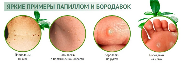 Клинические проявления ВПЧ инфекции на коже